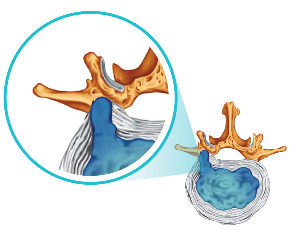 Slip Disc Treatment Kuala Lumpur
