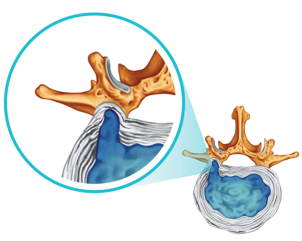 Slip Disc Treatment Kuala Lumpur